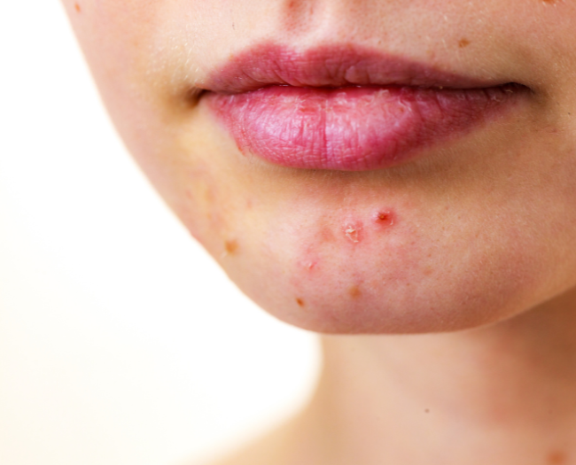 Acne on chin