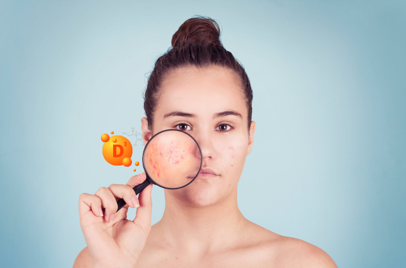 Can Vitamin D Supplements Cause Acne